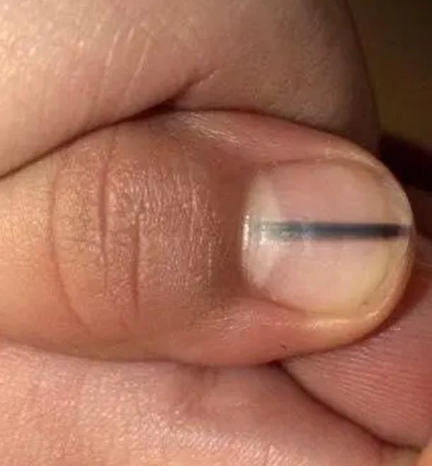 看看你的指甲有没有黑线白点,这些症状隐藏着你的健康