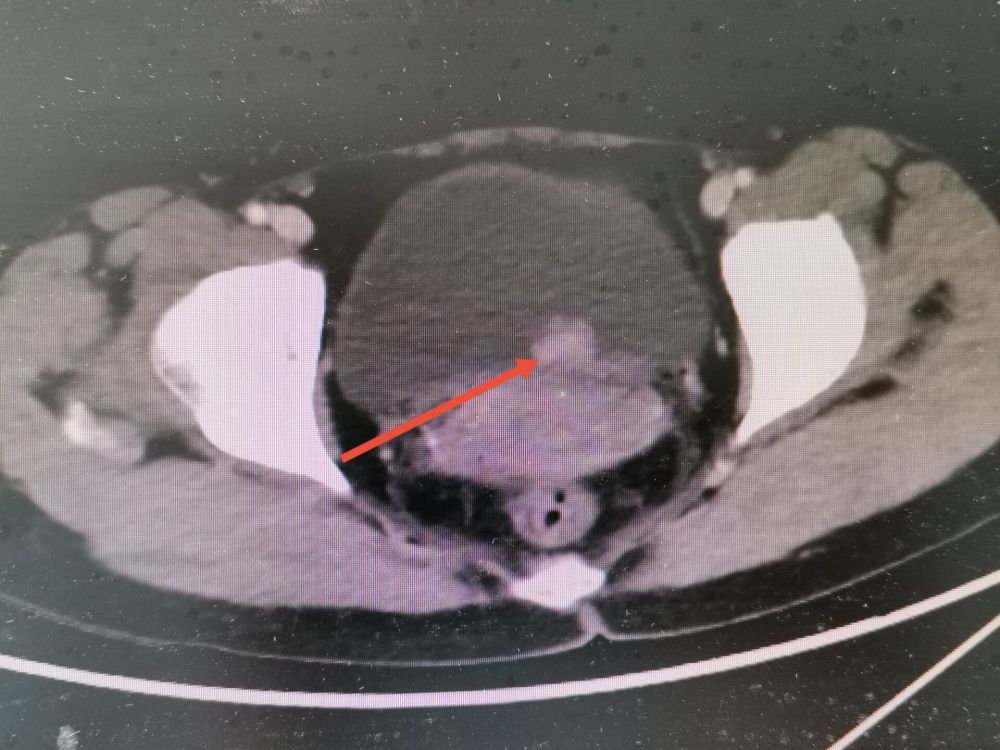 ct:红色箭头所指为膀胱肿瘤