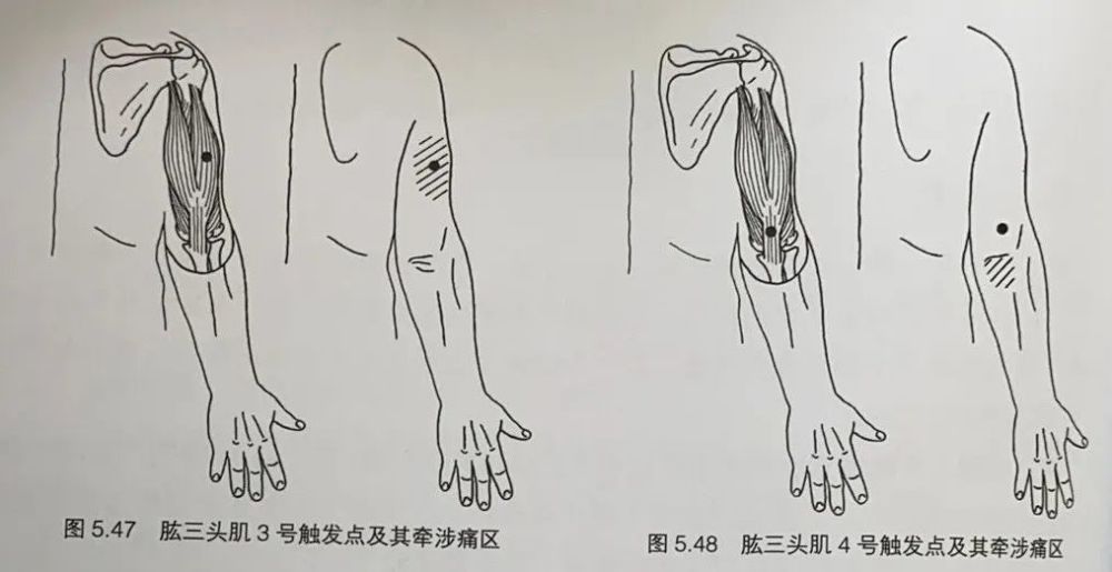 3号触发点 位于肱三头肌外侧头,引起的疼痛在它所在的上臂后区.