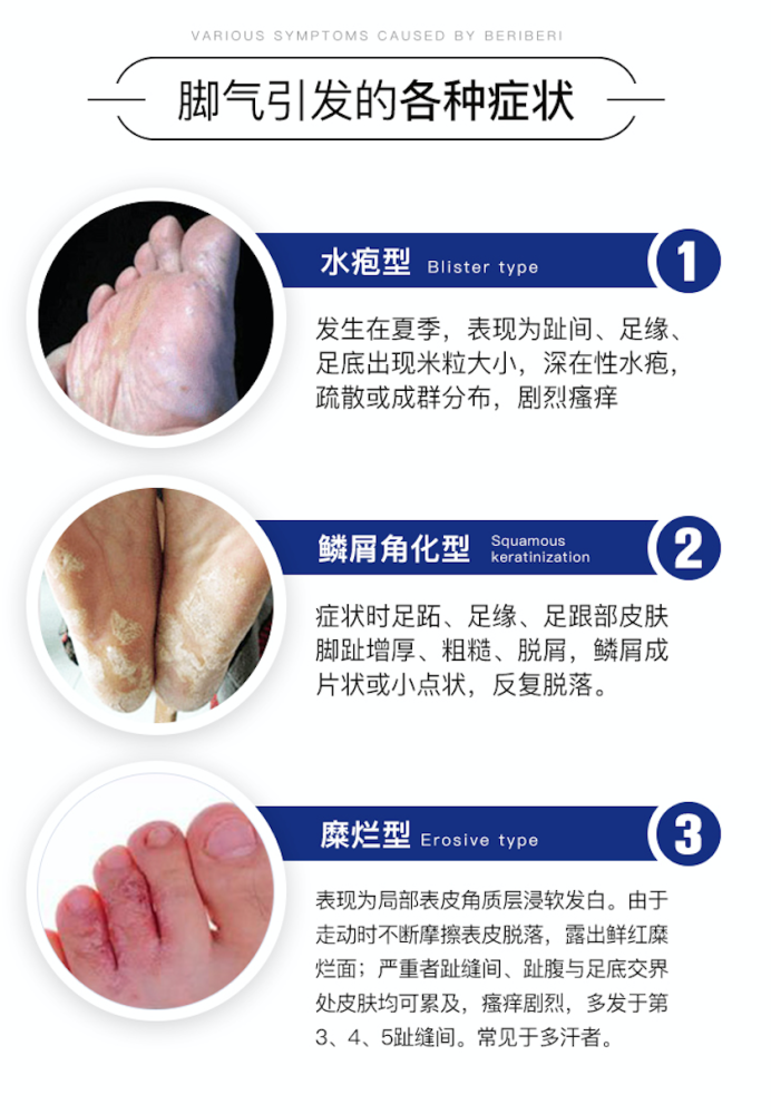 香港脚有救了一喷告别脚气脚臭脱皮瘙痒预防复发