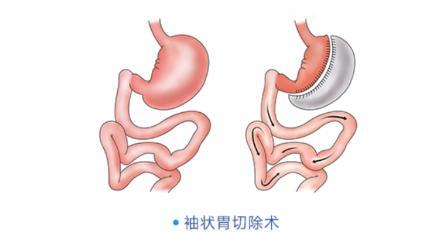 西安大兴医院微创外科施海:缩胃手术真的能减肥吗?