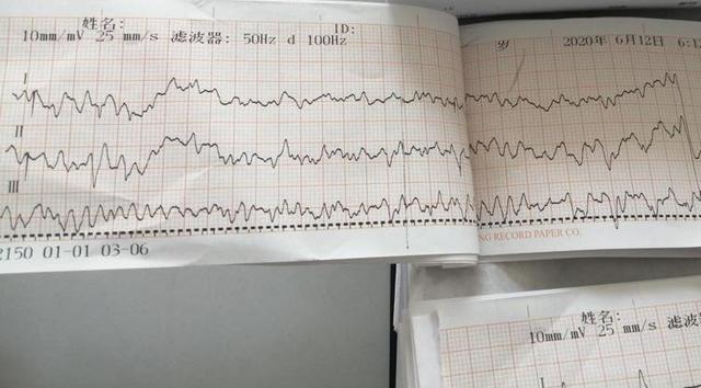 事发当时心电图显示患者室颤