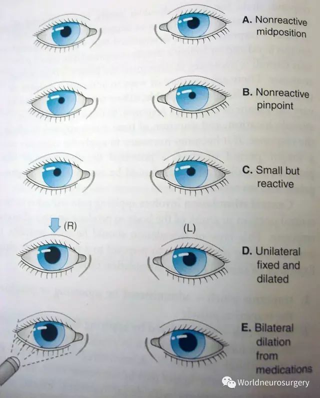 通过瞳孔定位神经病变这些图你看过吗