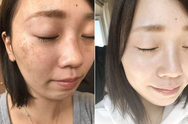 脸上长斑,难看又显老?建议睡前抹点它,你会比同龄人年轻10岁