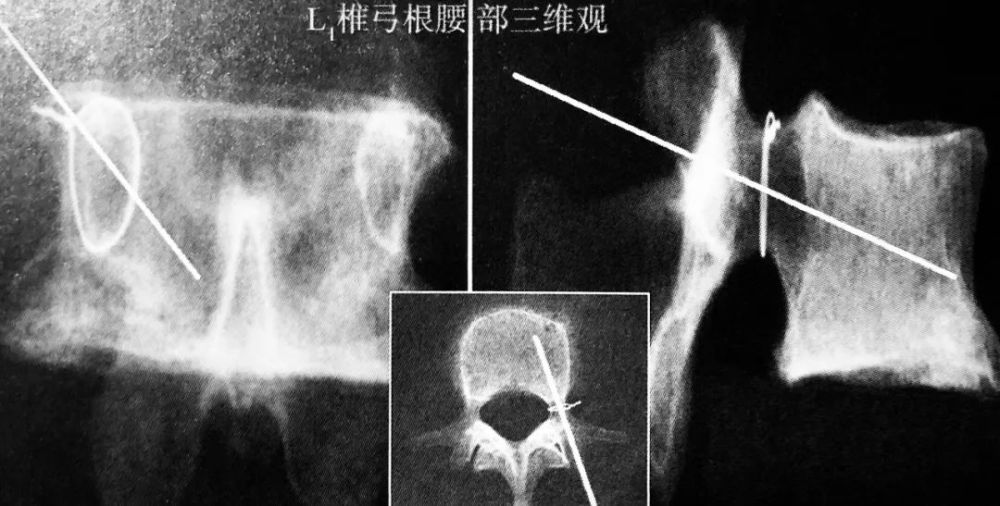 椎体骨折>3 个; t10椎弓根腰部三维观与穿刺路径 胸椎可采用经椎弓根