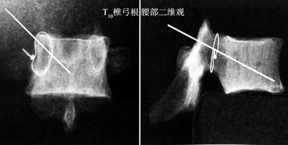 椎体骨折>3 个; t10椎弓根腰部三维观与穿刺路径 胸椎可采用经椎弓根