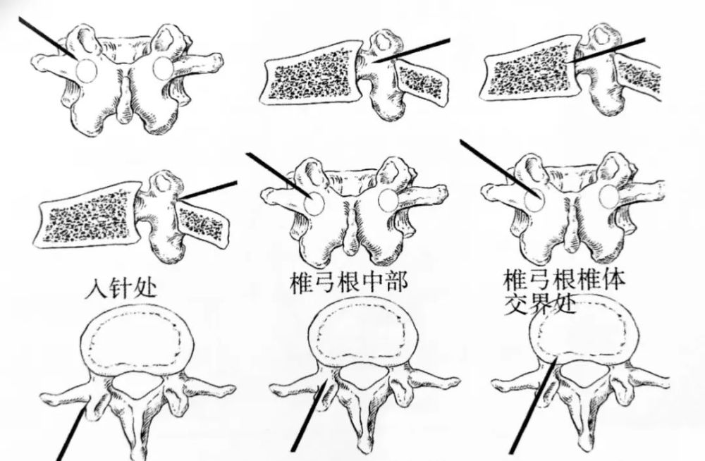 椎体骨折>3 个; 胸椎可采用经椎弓根途径或椎弓根旁路径即经肋骨-椎弓