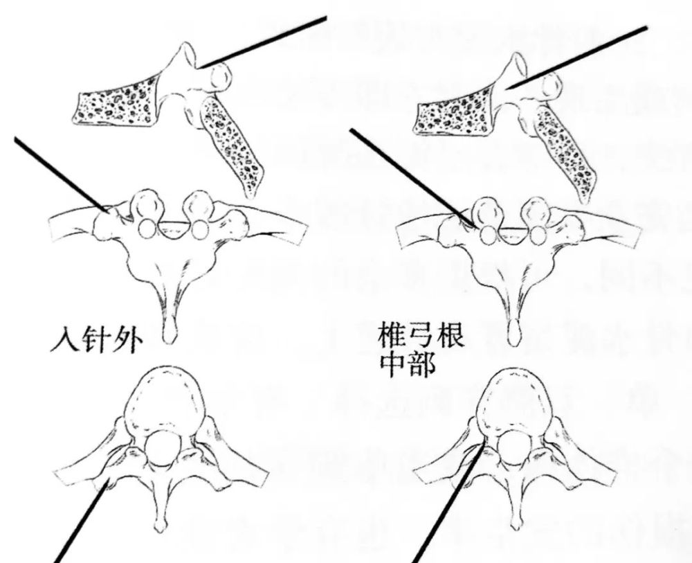 经椎弓根外路径穿刺椎弓根示意图