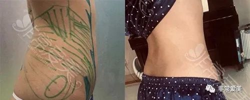 腰腹环吸一个月的图片对比,腹部环吸真心后悔啊!
