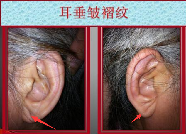 从耳朵判断你是否有冠心病,附食疗艾灸法