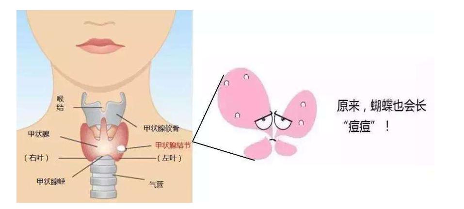 天天健康蝴蝶结不要纠节关于甲状腺癌的那些事儿