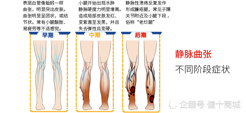 静脉曲张症状及如何预防