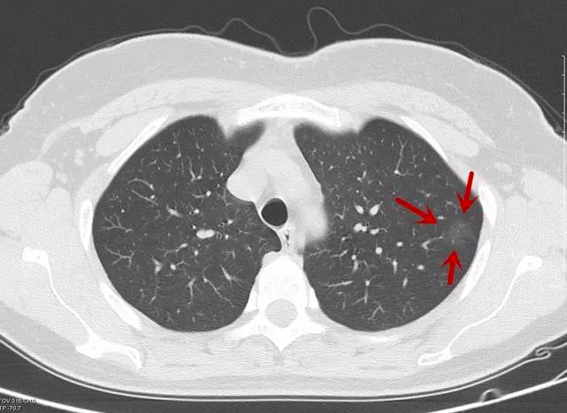 看不懂ct图像各种类型肺癌典型表现