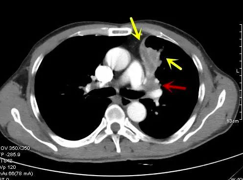 看不懂ct图像各种类型肺癌典型表现