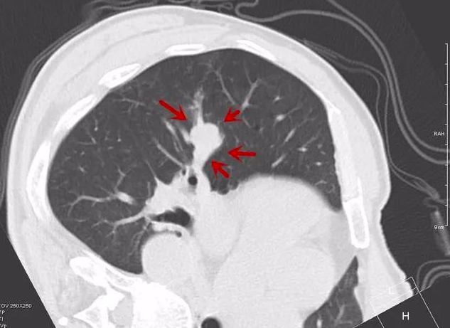 看不懂ct图像?各种类型肺癌典型表现!