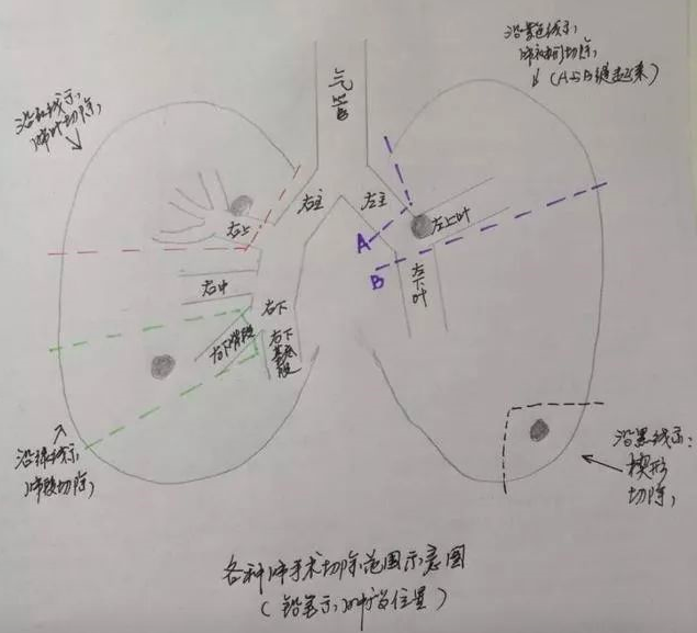 看不懂ct图像各种类型肺癌典型表现