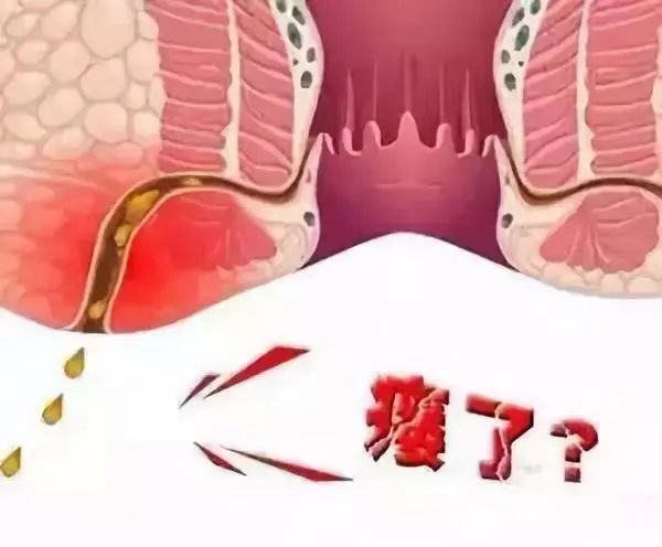 肛痿 1 肛瘘的症状是什么? 1