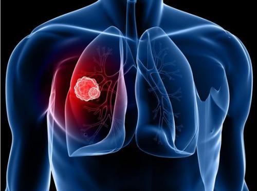 5种方式来确诊肺癌,带你全面了解肺癌的前生今世