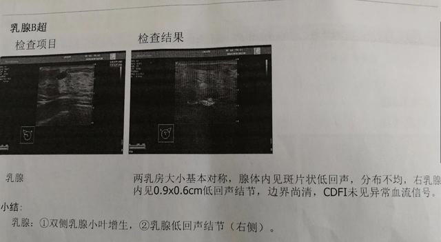 乳腺结节是本虚标实之证，中医辨证调治2个月，结节消失不见
