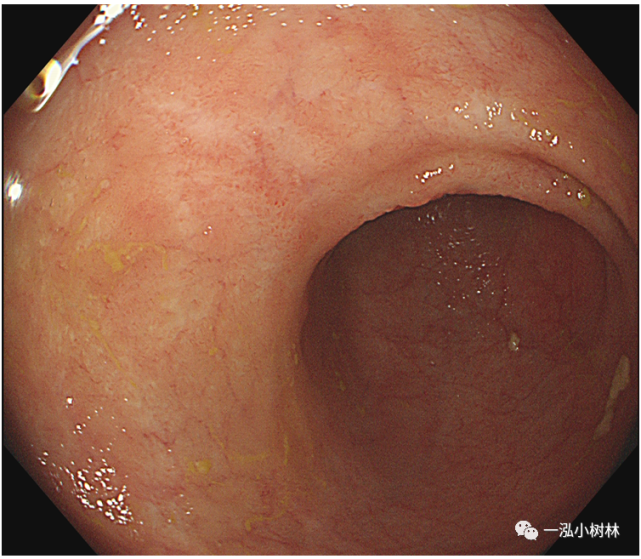 肠道病变内镜图片|内镜集锦