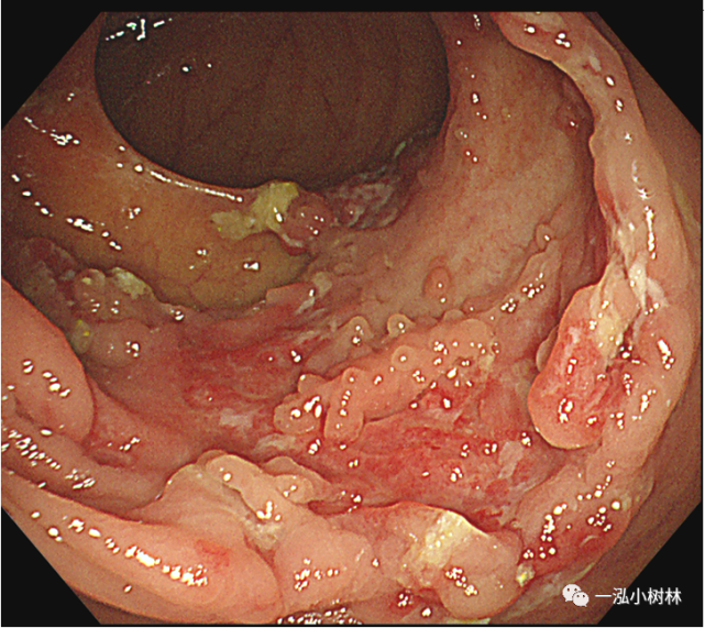 肠道病变内镜图片|内镜集锦