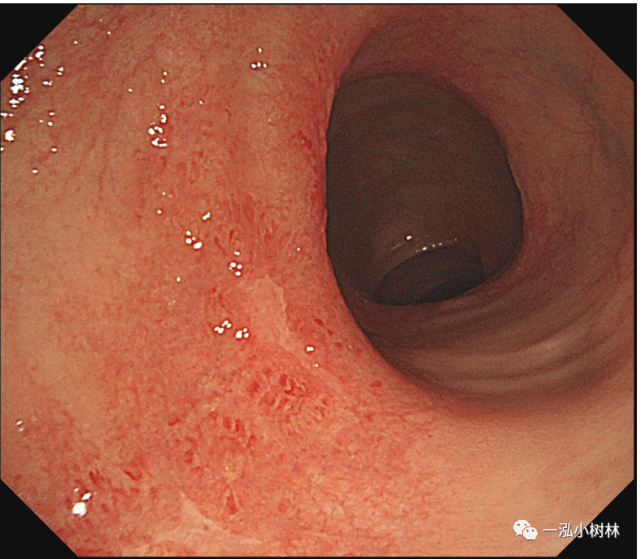 肠道病变内镜图片|内镜集锦