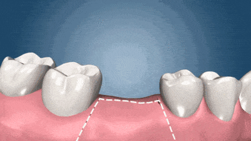 大连齿医生口腔科普 3分钟了解种植牙全过程!看后不再