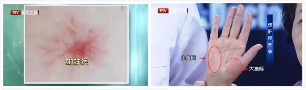 我国慢性肝病患者可能超4亿！比熬夜更伤肝的事，很多人还天天在做