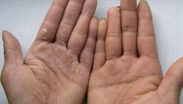 汗疱疹通常为两侧手足对称分布,不会传染,常见于手指侧面,严重的才会