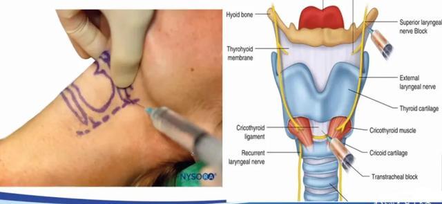柴彬:超声引导喉上神经阻滞的临床思维