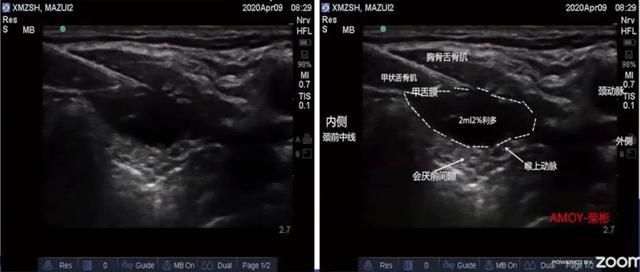 柴彬:超声引导喉上神经阻滞的临床思维