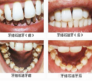 厦门牙齿美白科普:洗牙和牙齿美白是两码事儿!