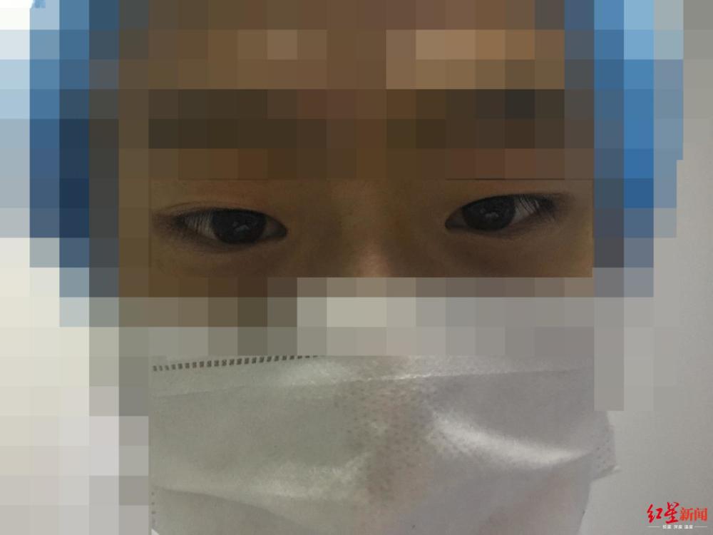 19岁的小伙突然成了“斗鸡眼”，到医院检查才发现，原来是…