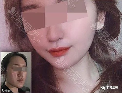分享一组韩国长脸整容后效果图,长脸变短后变化居然这么大!