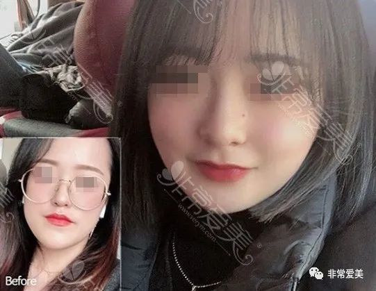分享一组韩国长脸整容后效果图,长脸变短后变化居然这么大!