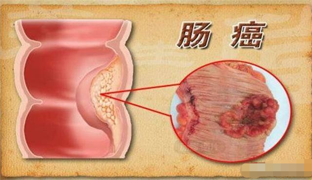 今天上班时听说一位同事得了肠癌,很突然,请问得了肠癌有什么前期症状