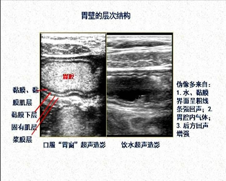 胃黏膜淋巴瘤胃溃疡十二指肠球部溃疡胃底静脉曲张胃间质瘤胃息肉胃