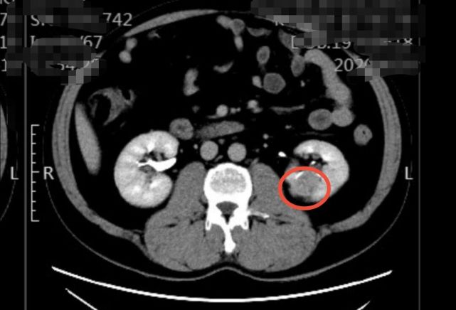 增强ct显示左肾癌,红色圆圈内为小肾癌