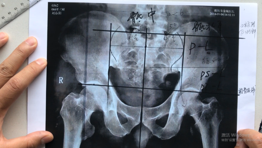 全脊柱关节手法教学影像读片体态调整脊椎相关疾病