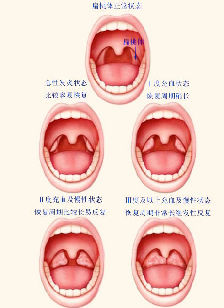 小儿扁桃体发炎反复发作,该如何是好?_腾讯新闻