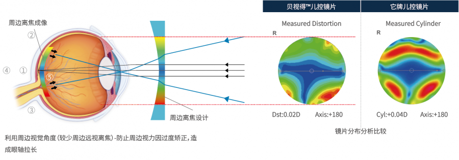 角膜塑形镜——青少年近视防控好帮手,太学眼科倾情献礼