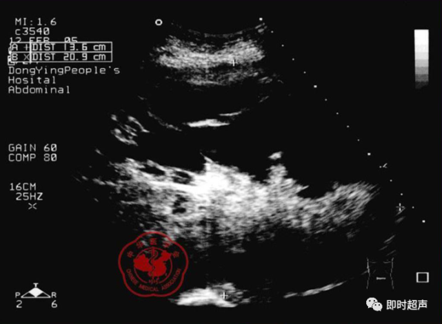 胃间质瘤的超声表现