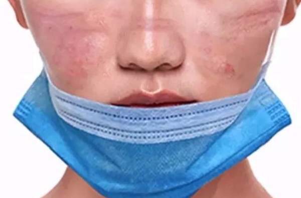 你是否戴口罩过敏,戴口罩有口臭,真的是口罩的问题?