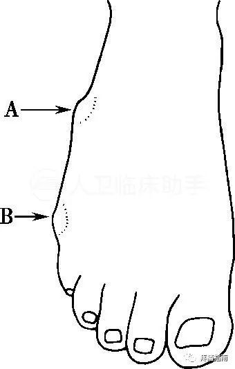 足背观察 (2)注意是否有(a)楔状骨的外生骨疣(b)背侧腱鞘囊肿.