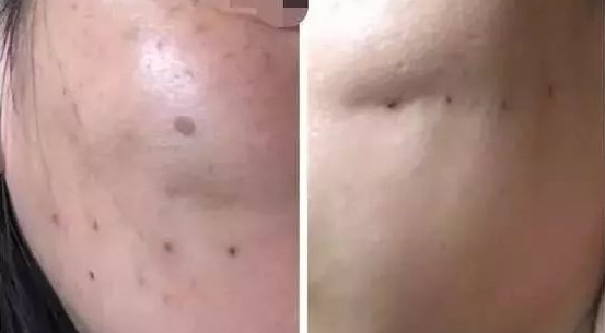 小姑的面部线雕术失败案例告诉你线雕脸部提升的后遗症别害怕