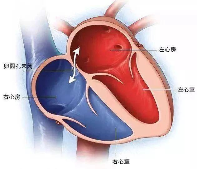 卵圆孔未闭与房间隔缺损的区别