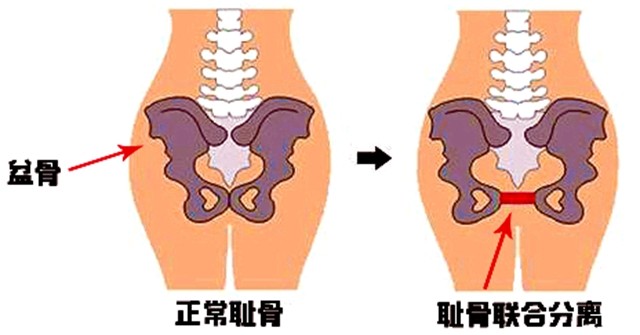到了孕晚期, 韧带变松,为宝宝出生做准备,于是出现了"耻骨分离".