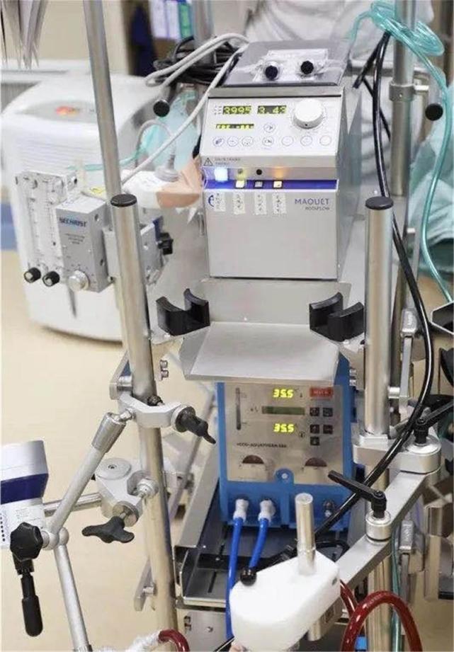 体外膜肺治疗仪(ecmo)