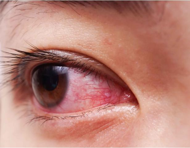 眼睛常有红血丝?三个小方法可缓解,该如何预防?
