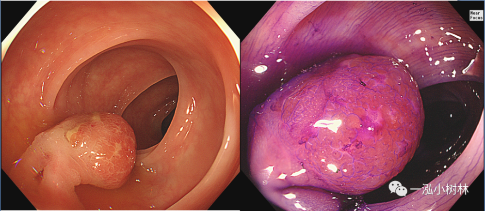 结肠管状腺瘤